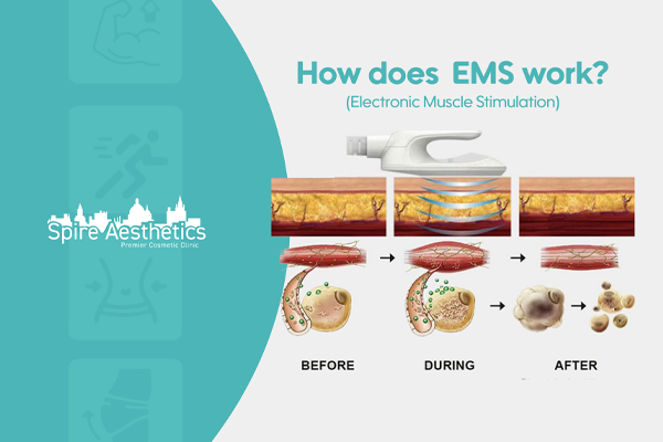 EMS treatment for post pregnancy weight loss treatment Greenford