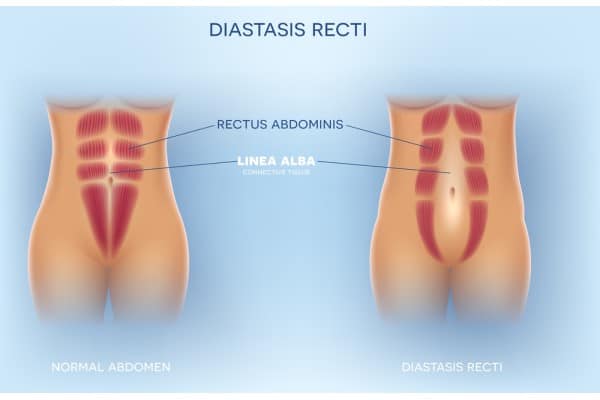 What Non-Surgical Options Are Available for Diastasis Recti Greenford?