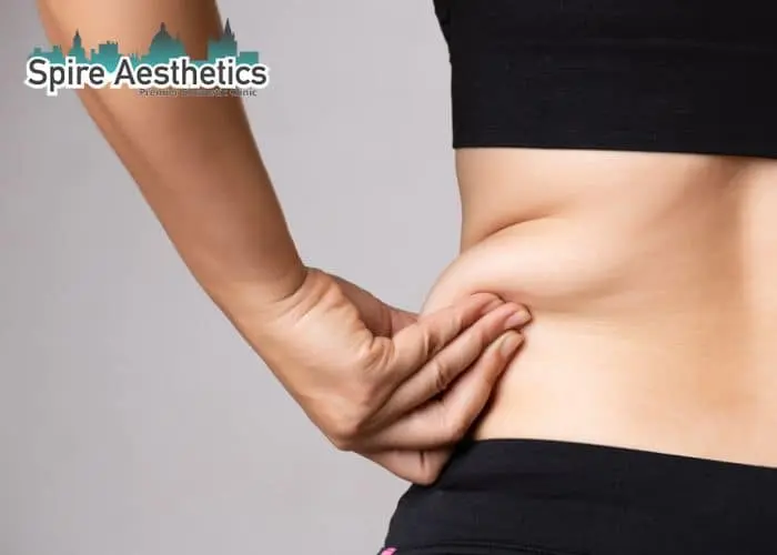 Image of woman pinching fat on their hips Greenford. Fat Freezing treatment