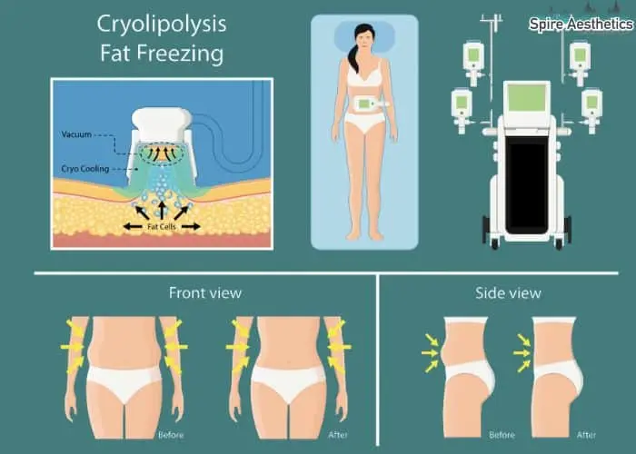 Fat freezing treatment Greenford benefits for competitions to remove stubborn fat deposits.