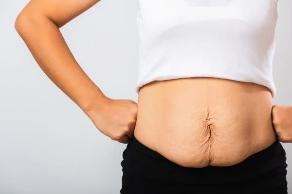 Image of a woman's stomach after weight loss with sagging skin following a gastric band Greenford