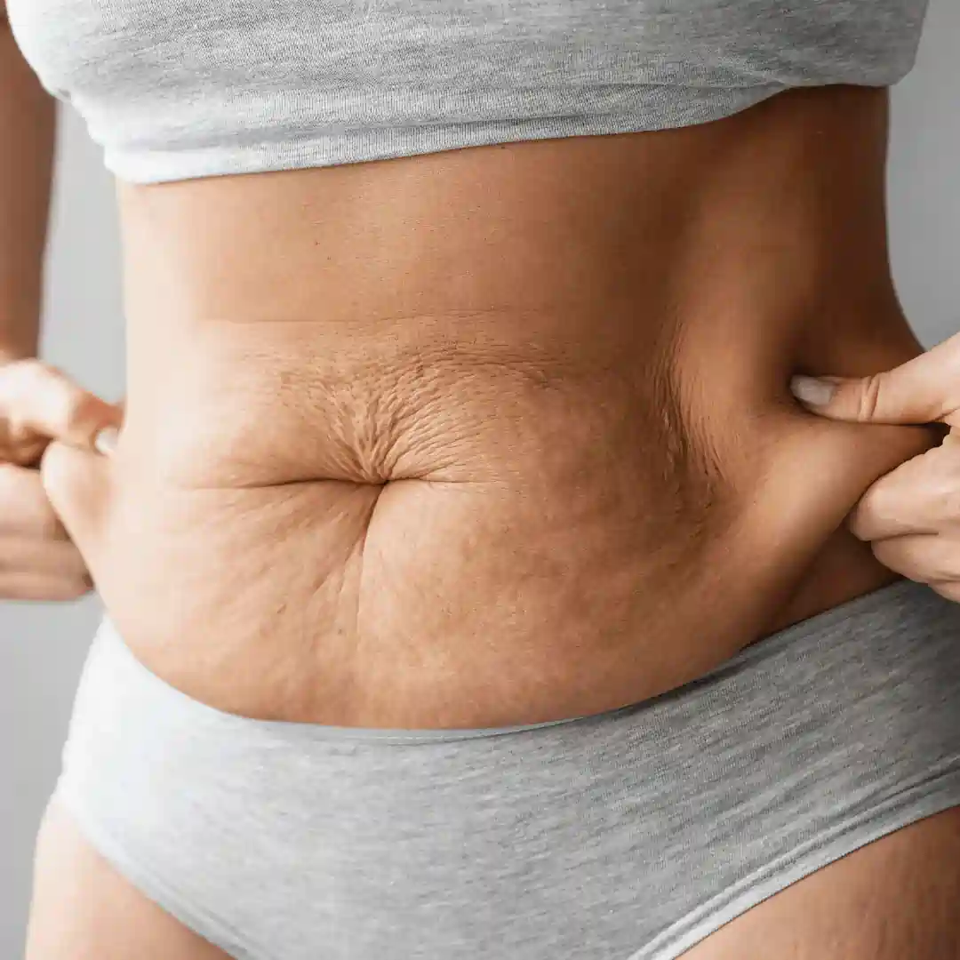 Is It Normal to Have Loose Skin After Pregnancy Greenford?