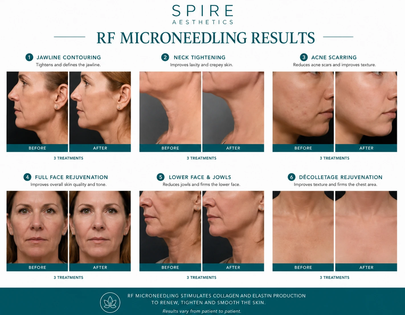 RF Microneedling Skin tightening Greenford results