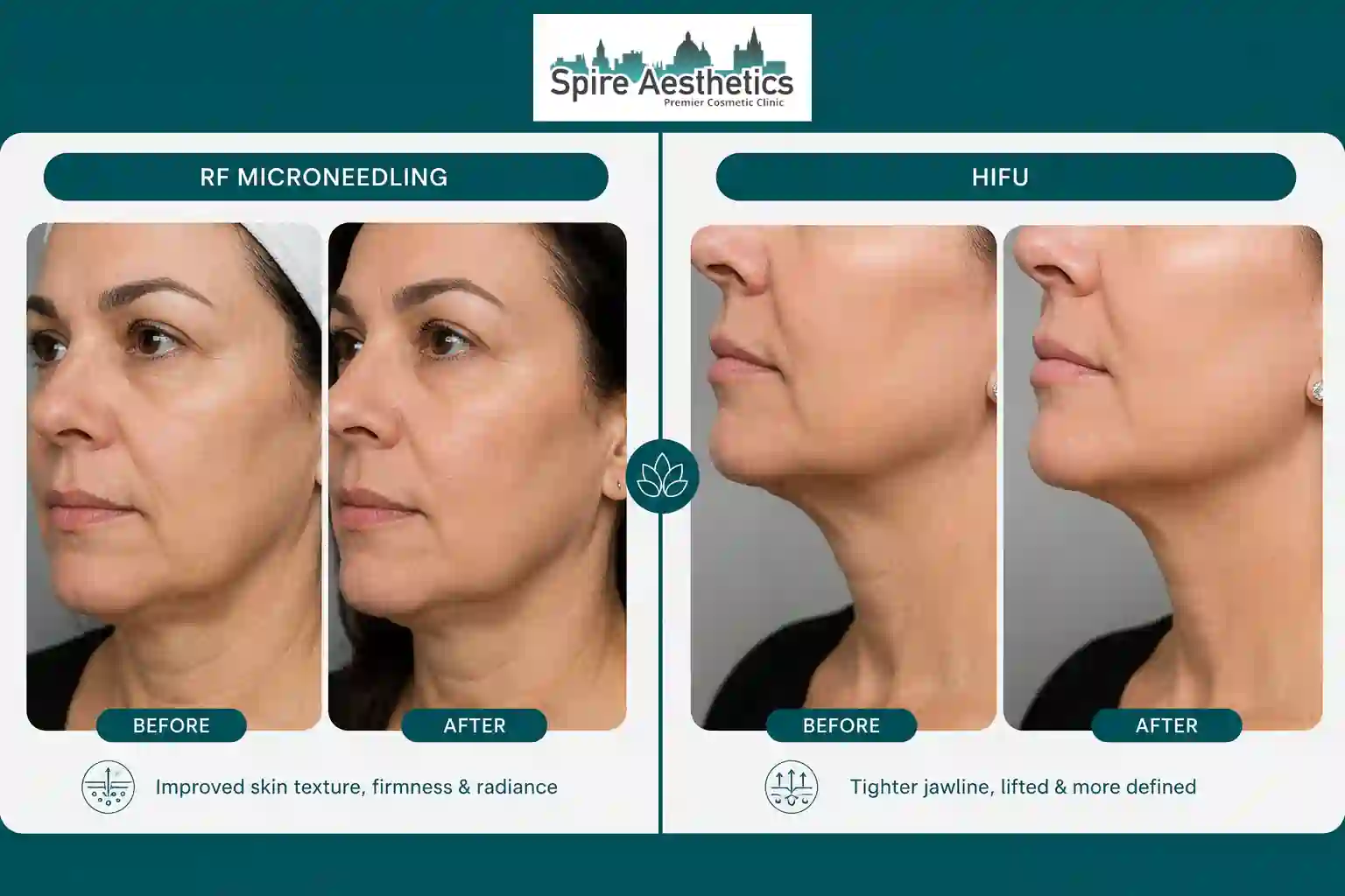 Can RF Microneedling and HIFU Be Combined Greenford?