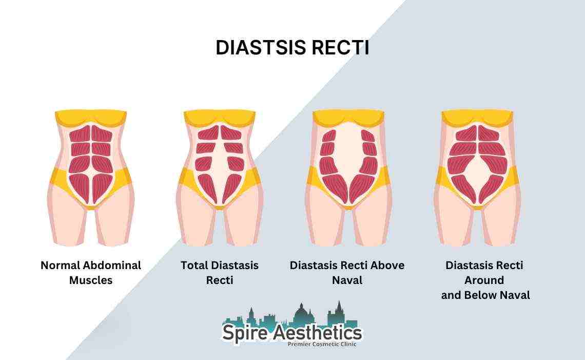 Is Non-Surgical Diastasis Recti Treatment Right for You? Common Concerns Answered Greenford